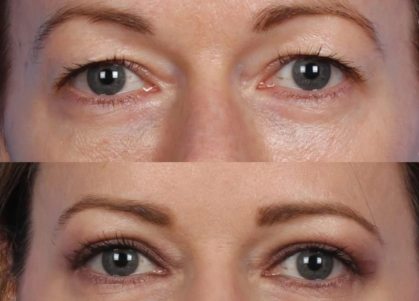 Поднять веки ботоксом фото What is Hooded Eye Surgery? Your Definitive Guide to Blepharoplasty