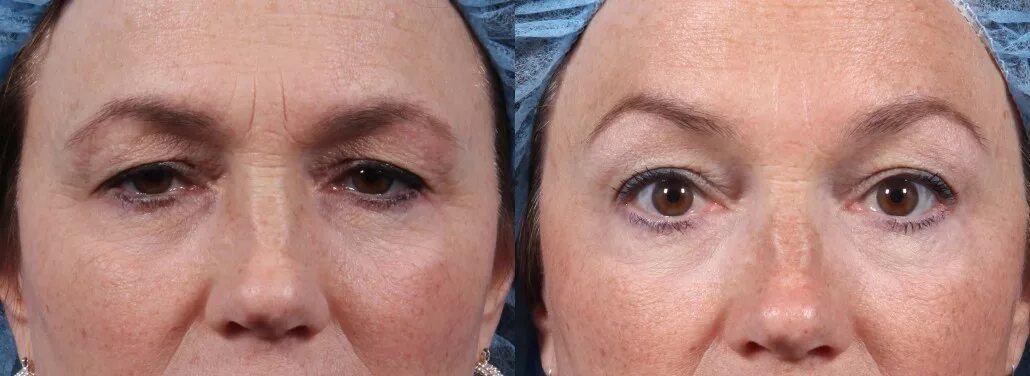 Поднять веки ботоксом фото Brow Lifts NYC Dr. Brett Kotlus, Cosmetic Oculoplastic Surgeon