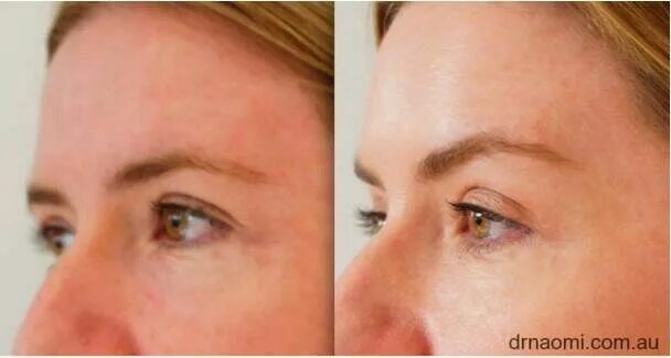 Поднятие бровей ботоксом фото Eyebrow botox lift Botox brow lift, Brow lift, Botox