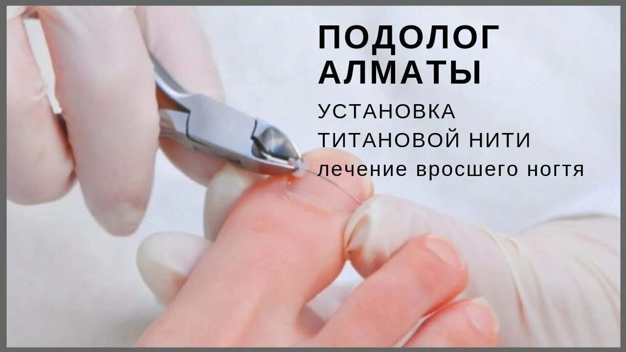 Подолог в энгельсе цена и отзывы фото Подолог Алматы Установка титановой нити Лечение вросшего ногтя - YouTube