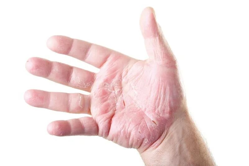 Подошвенно ладонный псориаз фото начальная стадия Hand and finger eczema (chronic hand eczema) Ducray