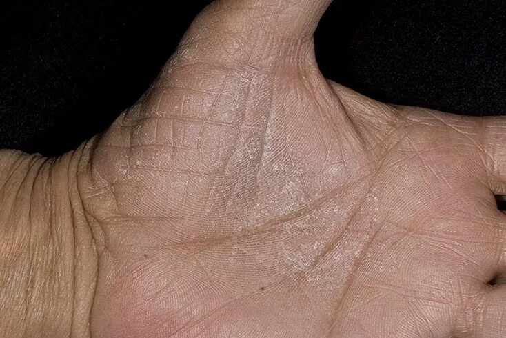 Подошвенно ладонный псориаз фото начальная стадия Dry Eczema on Hands Pictures - 475 Photos & Images / illnessee.com