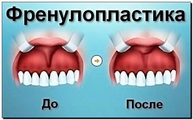 Подрезать уздечку верхней губы взрослому фото Пластическая операция уздечки языка и губ Вологда