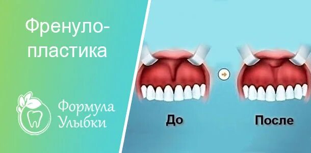 Подрезать уздечку верхней губы взрослому фото Удаление уздечки верхней губы лазером до и после - TouristMaps.ru