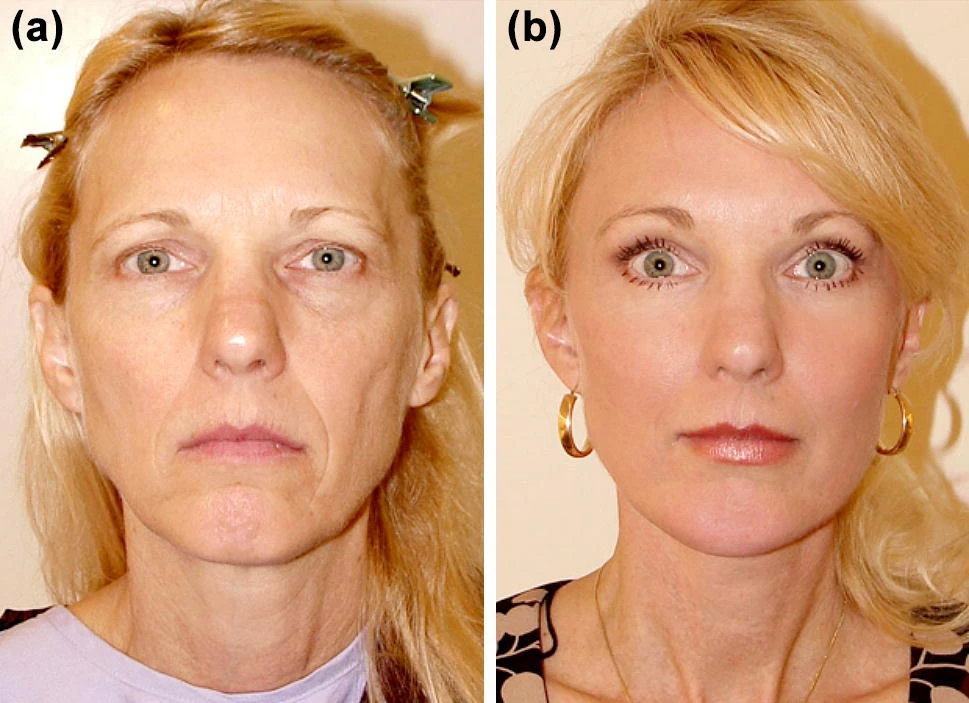 Подтяжка глаз фото Facial Fat Grafting: Why, Where, How, and How Much - Aesthetic Plastic Surgery F