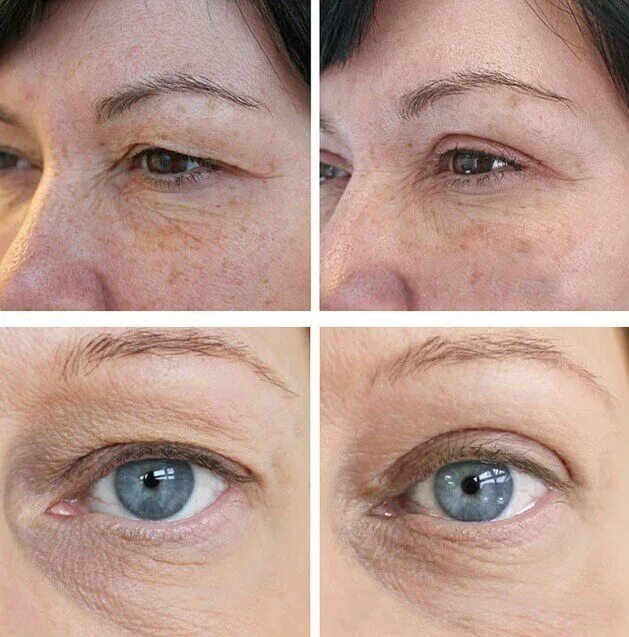 Подтяжка глаз фото Blepharoplasty - Coolaser Clinic