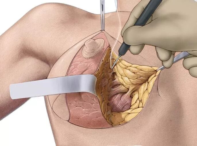 Подтяжка груди фото до и после операции Якорная подтяжка груди (грудных желез) Т-образная мастопексия в Москве