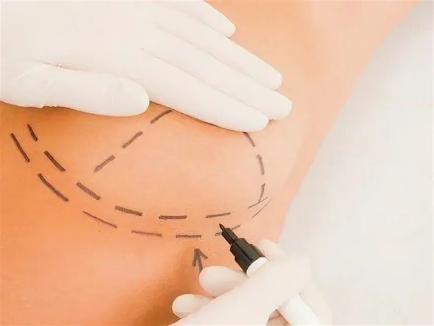 Подтяжка груди нитями фото до и после Surgical Procedures helping you to get Desirable Breasts