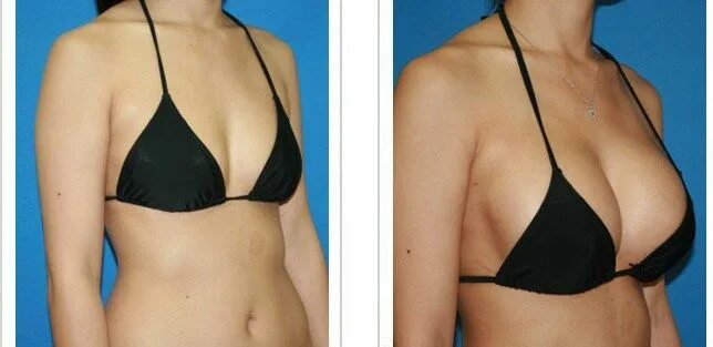 Подтяжка груди новосибирск фото breast-augmentation-before-after Augmentation Silicone implants, Breast