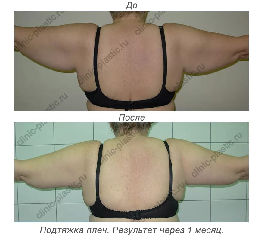 Подтяжка груди ставрополь цена фото Методы подтяжки груди. Виды операции, как делается, фото до и после