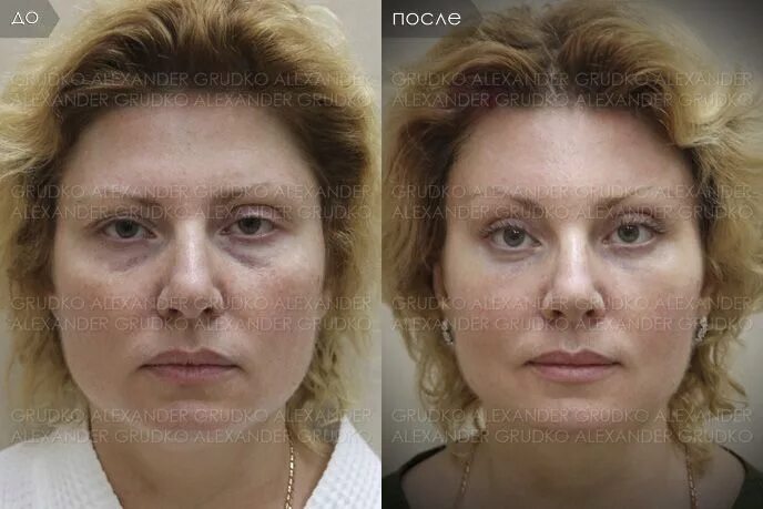 Подтяжка лба и бровей фото Фотографии до и после операции. Пациентке выполнена эндоскопическая подтяжка бро