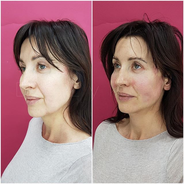 Подтяжка лица нитями до и после фото Thread Lifting, Before and After Photo Face surgery, Thread lift, Face