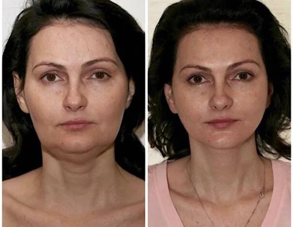 Подтяжка лица отзывы фото Need models for face rejuvenation procedure for FREE: SMAS-lifting. Results for 