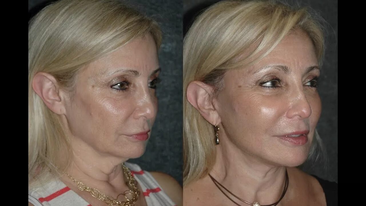 Подтяжка нити до и после фото Local Anesthesia Neck Lift Before and After #necklift - YouTube