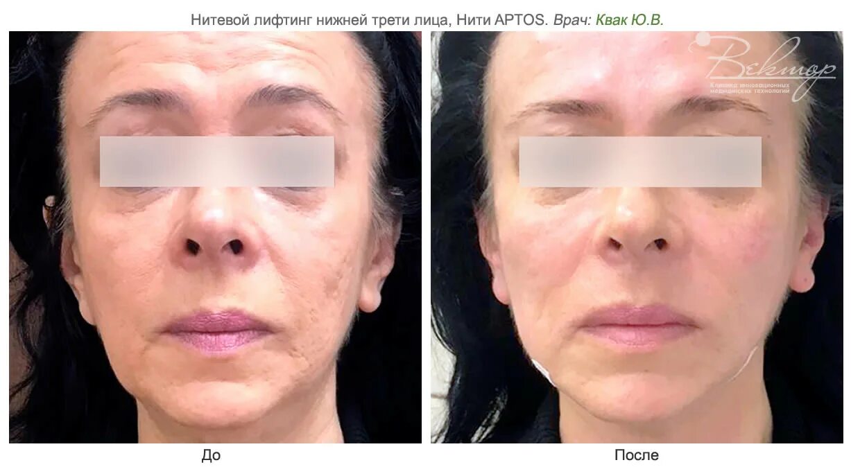 Подтяжка нижней трети лица фото Подтяжка нитями (нитевой лифтинг) Dermafil, APTOS, Мезонити в клинике инновацион