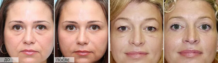 Подтяжка век нитями фото About mimic wrinkles around the eyes: how to get rid of at home, means