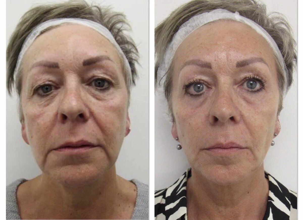 Подтяжка век нитями фото до и после Thread Lift: Complications, Before and After, Recovery, and Cost Facial, Rostros