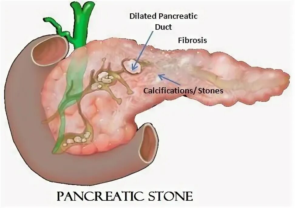 Поджелудочная железа камни фото Pin on Pancreatic and stomach cancer Symptoms, Causes and Treatment