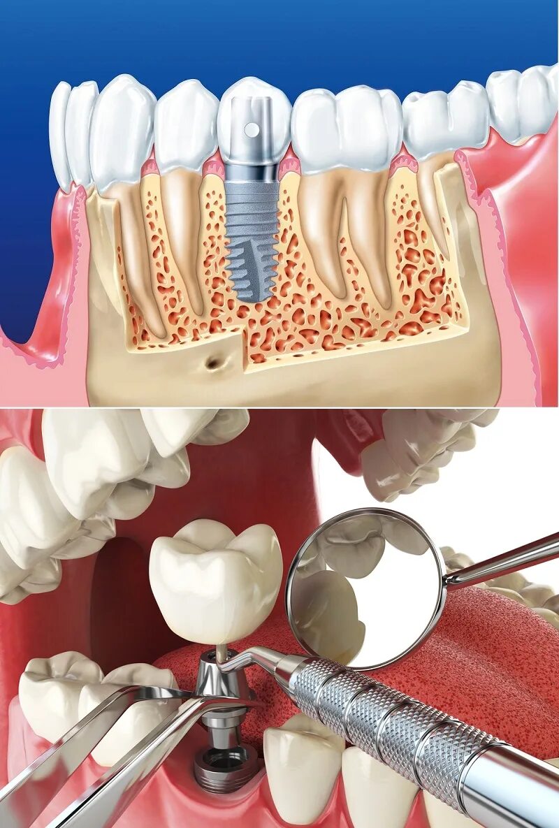 Поэтапная установка импланта зуба фото Новости медицины