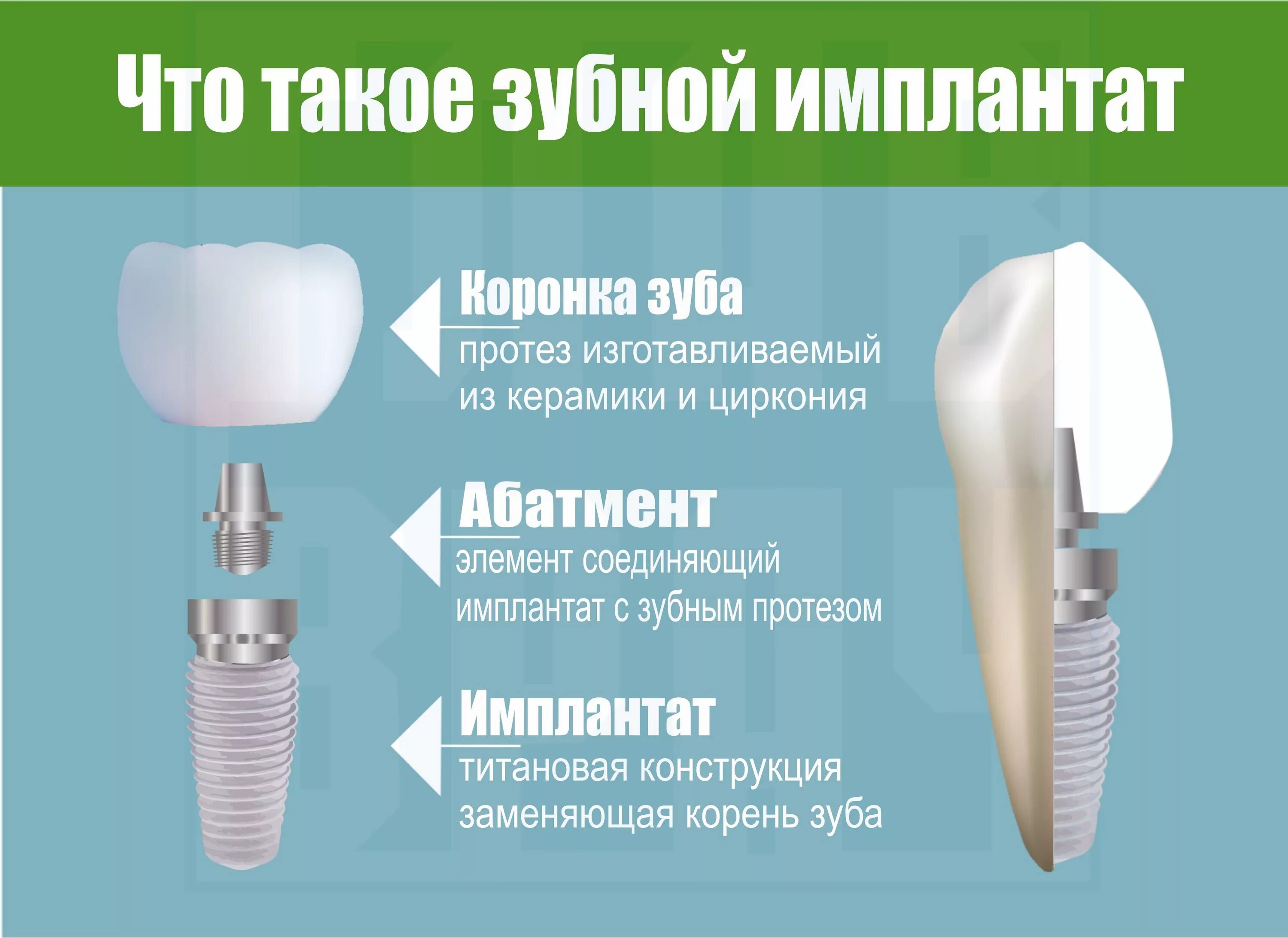 Поэтапная установка импланта зуба фото Имплантация Зубов: Современное Решение для Восстановления Улыбки