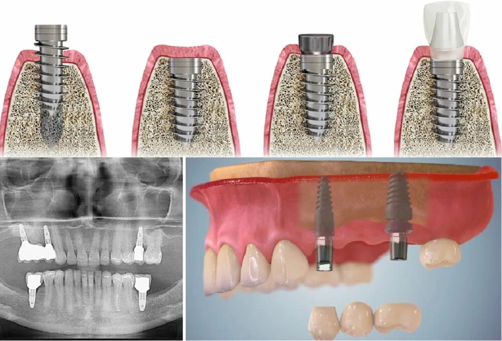 Поэтапная установка импланта зуба фото Разнообразие зубных имплантатов: какие бывают и как выбрать правильно