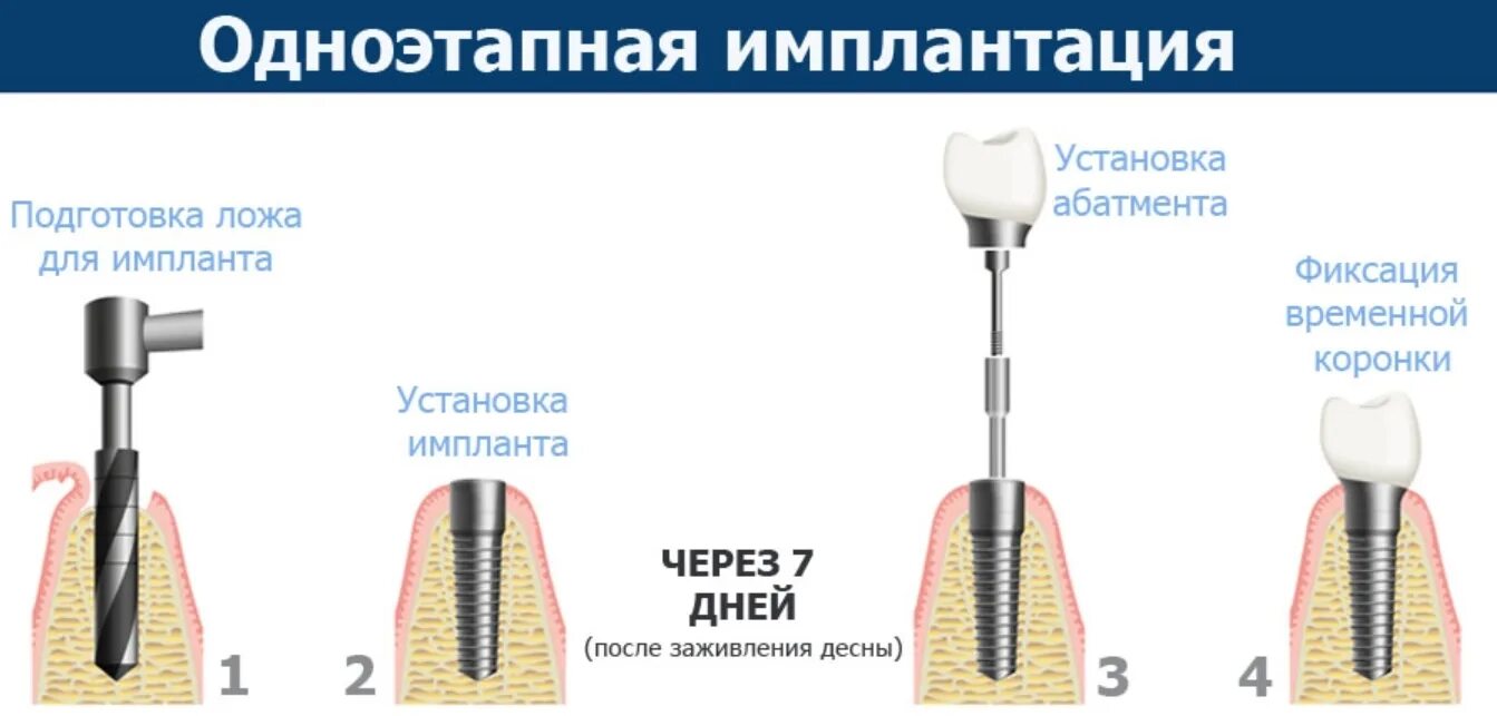 Поэтапная установка импланта зуба фото Протокол дентальной имплантации