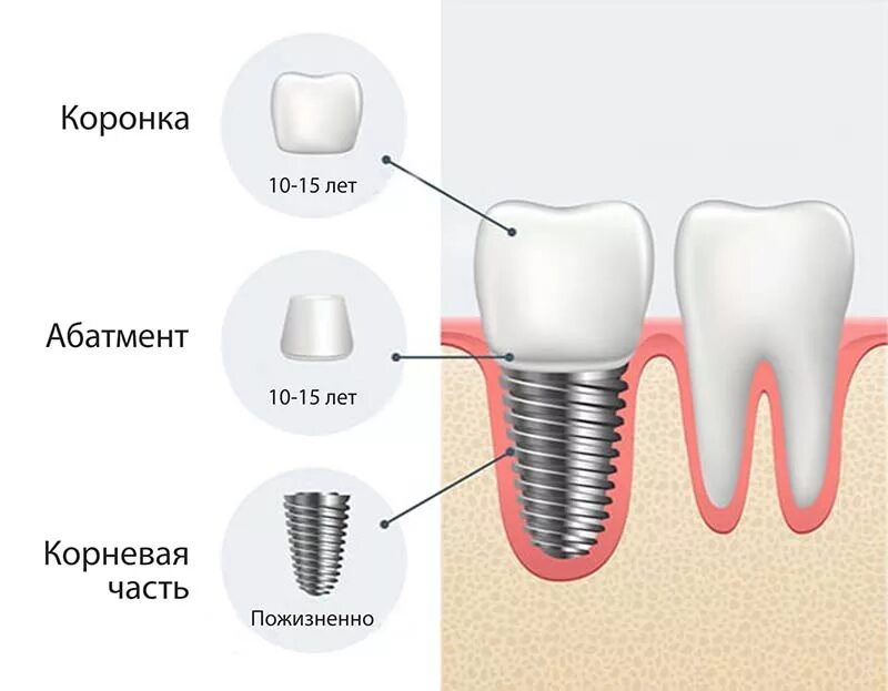 Поэтапная установка импланта зуба фото Сроки гарантии на импланты зубов