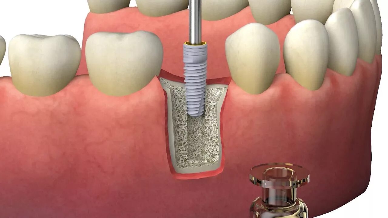 Поэтапная установка импланта зуба фото Установка имплантата Bio3 с применением нового имплантовода-адаптера ITBN18 и но