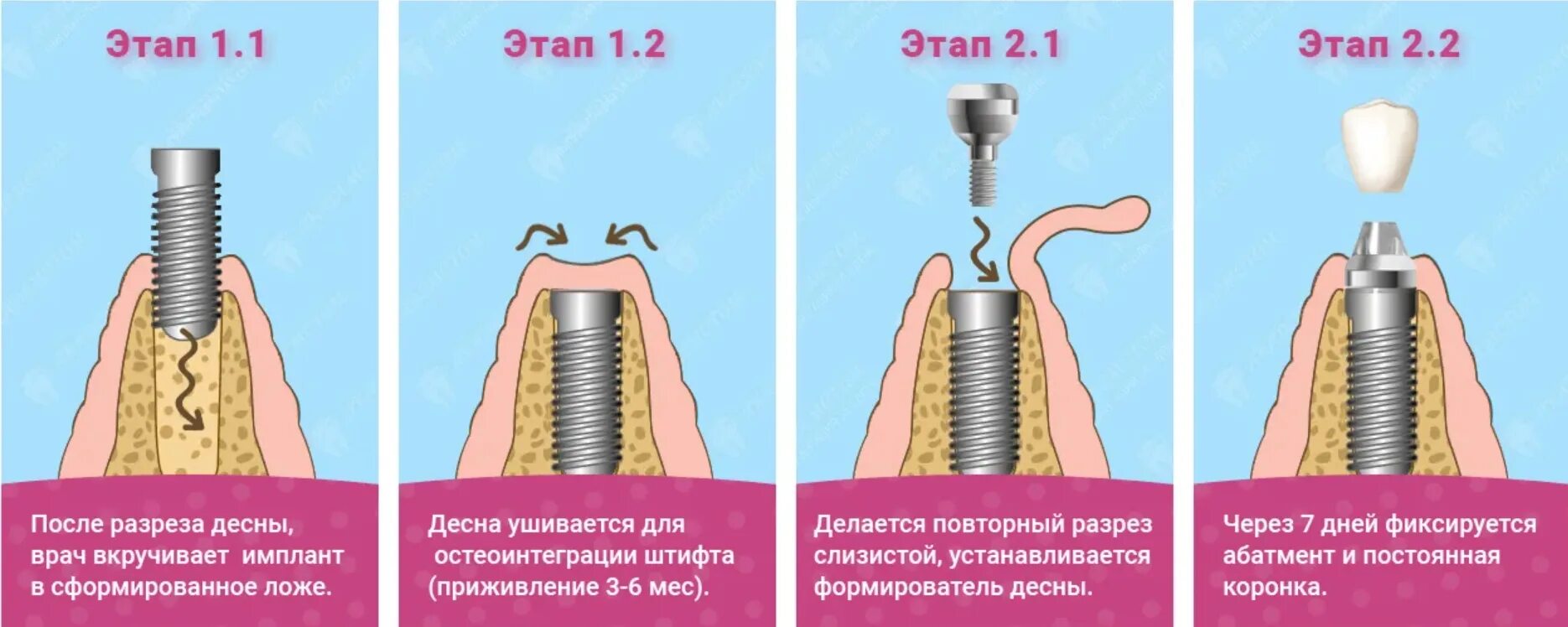 Поэтапная установка импланта зуба фото Имплантация зубов: основные этапы операции