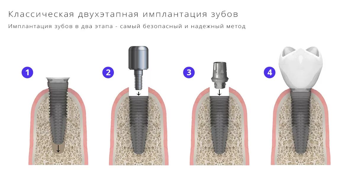 Поэтапная установка импланта зуба фото Двухэтапная имплантация зубов классическая имплантация, цена