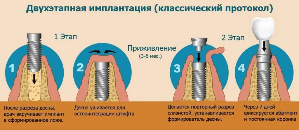 Поэтапная установка импланта зуба фото Имплантация зубов в Москве - цена от 20 990 руб (имплант + установка) в "Центре 