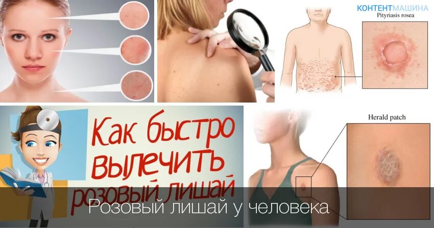 Показать фото как выглядит лишай Розовый лишай у собаки: симптомы и лечение причины