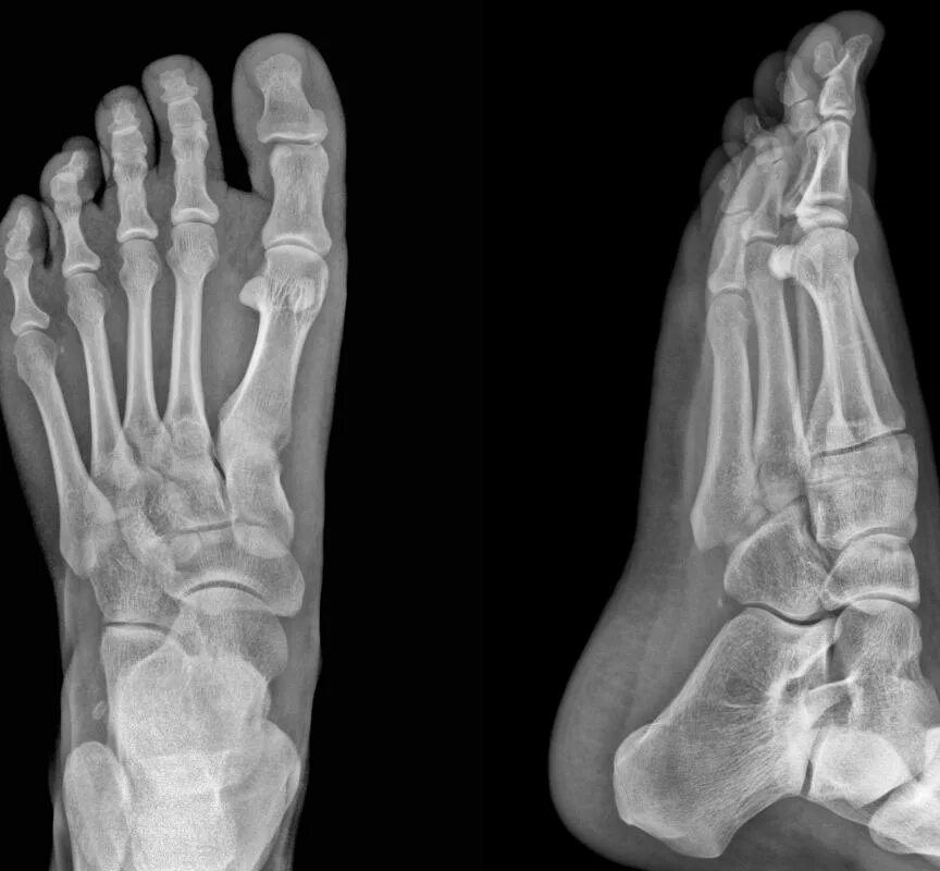 Показать фото стопы кость What is the Calcaneus? (with pictures)