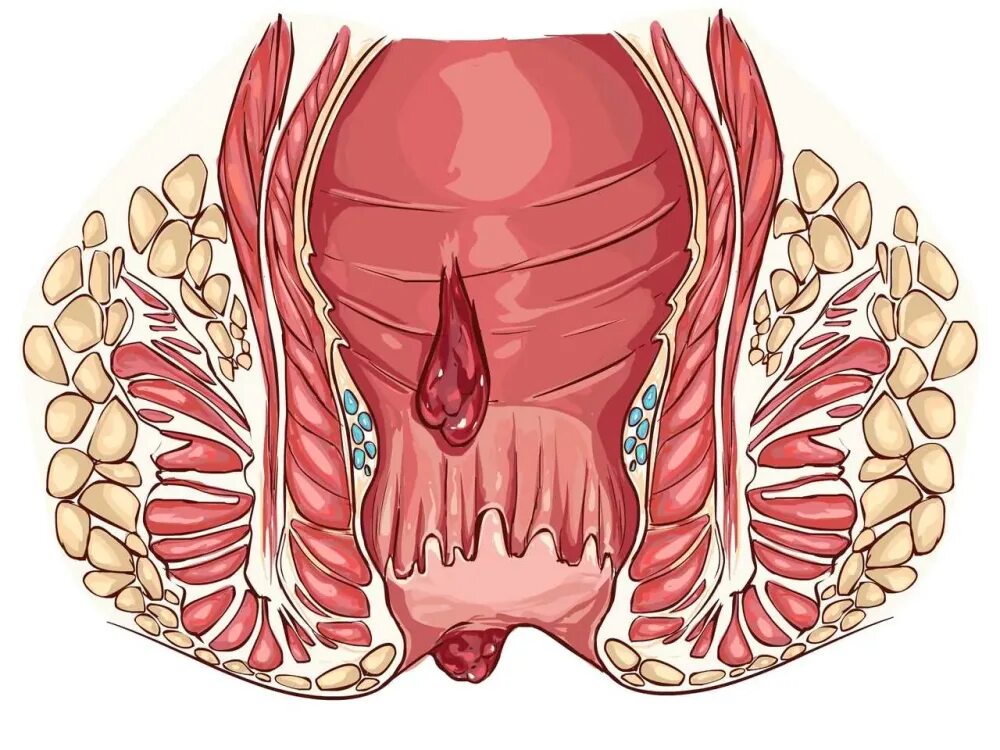 Показать как выглядит геморрой Хронический геморрой: причины, симптомы и методы диагностики