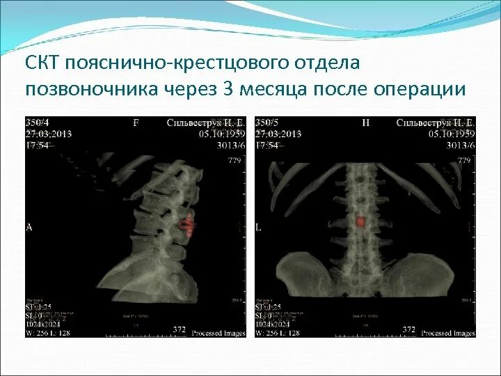 Показать пояснично крестцовый отдел позвоночника фото Рисунок пояснично крестцового отдела позвоночника