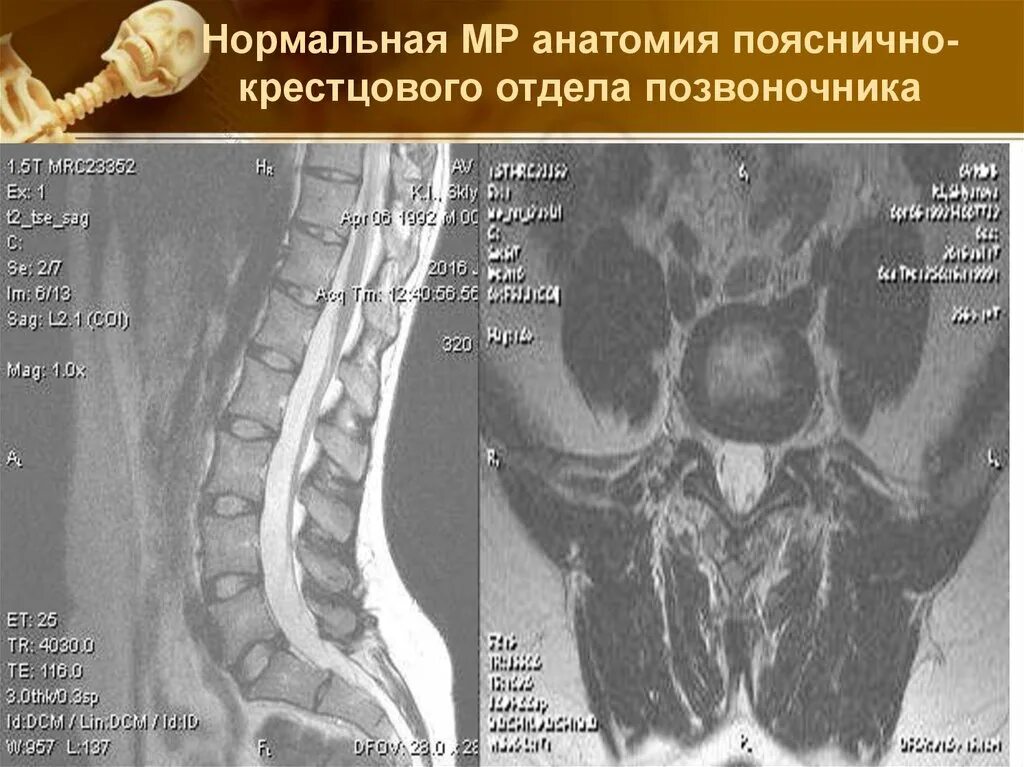 Показать пояснично крестцовый отдел позвоночника фото Интересные случаи в МРТ - презентация онлайн