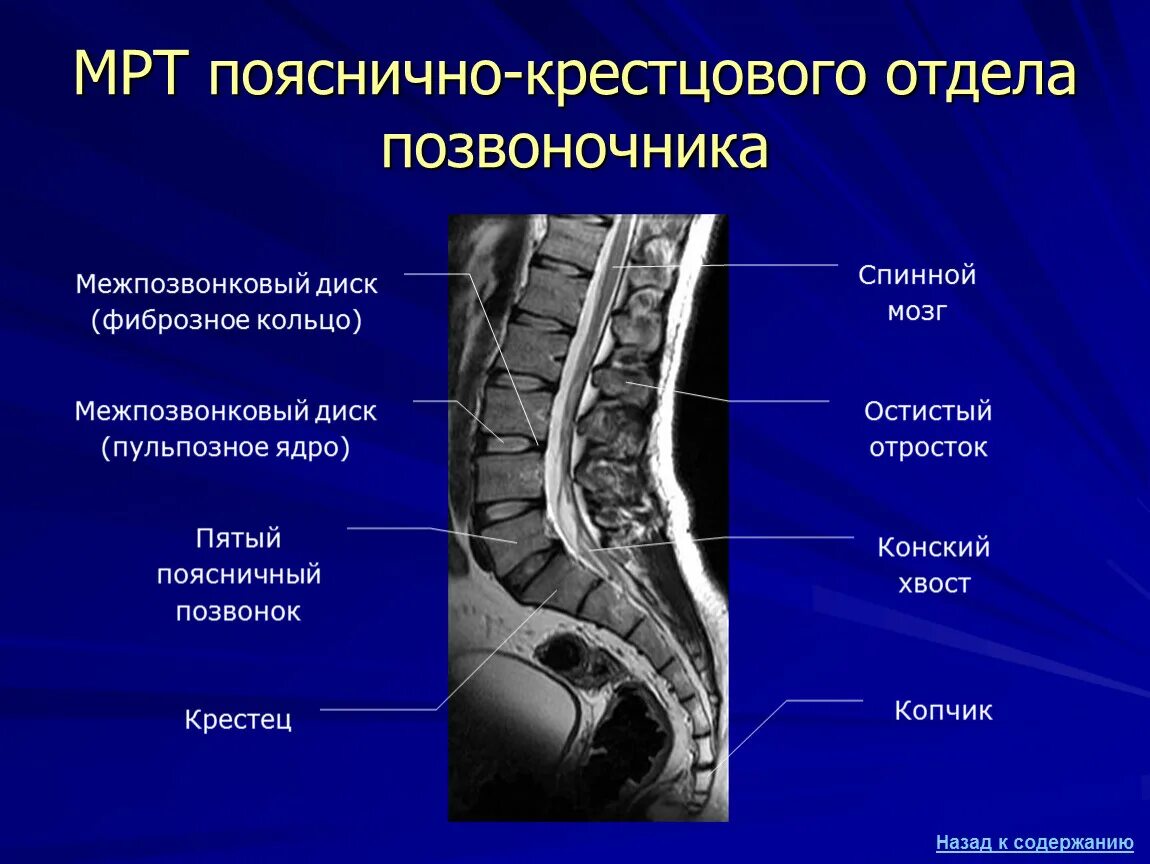 Показать пояснично крестцовый отдел позвоночника фото Мрт пояснично крестцового и копчика