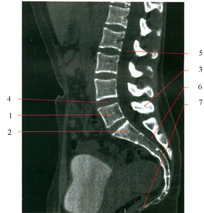 Показать пояснично крестцовый отдел позвоночника фото Компьютерная томография, современные мультиспиральные компьютерные томографы, мр