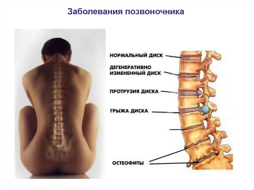 Показать поясничный отдел позвоночника фото Позвоночник форум пациентов: найдено 84 картинок