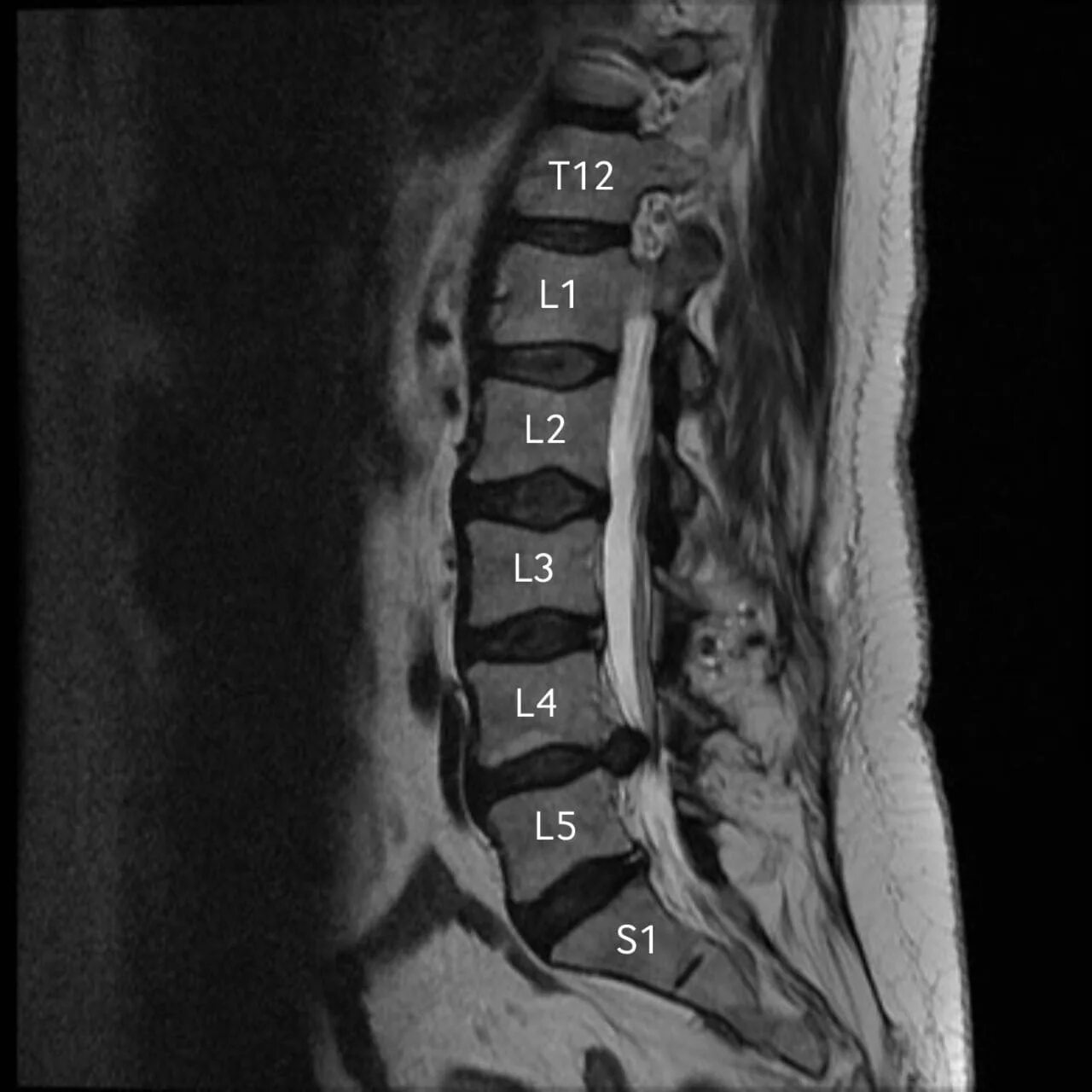Показать поясничный отдел позвоночника фото МРТ при болях в пояснице - томография позвоночника с бесплатной консультацией не