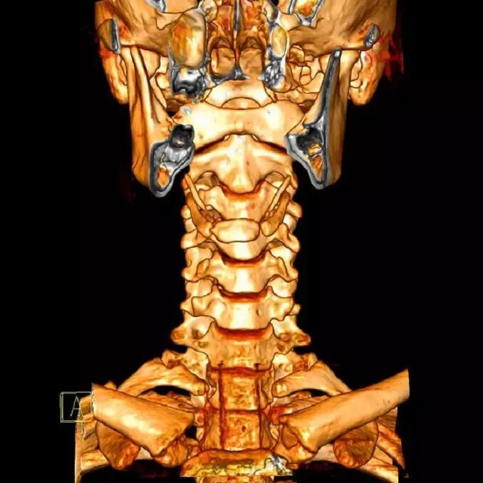 Показать шейный отдел позвоночника фото Что показывает КТ шейного отдела, как подготовиться к компьютерной томографии ше