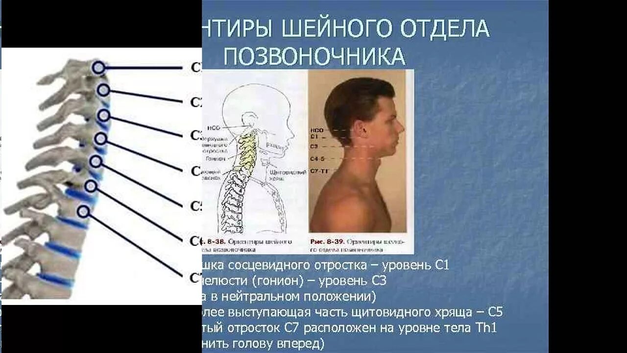 Показать шейный отдел позвоночника фото Боль в шее, возможные симптомы при поражении шейного отдела позвоночника - YouTu