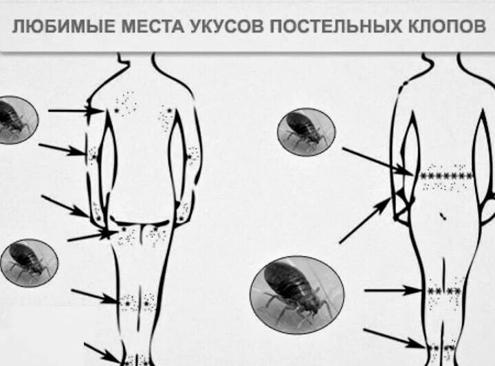 Показать укусы клопов на теле человека фото Чешутся ли укусы клопов? Признаки и симптомы укуса клопа