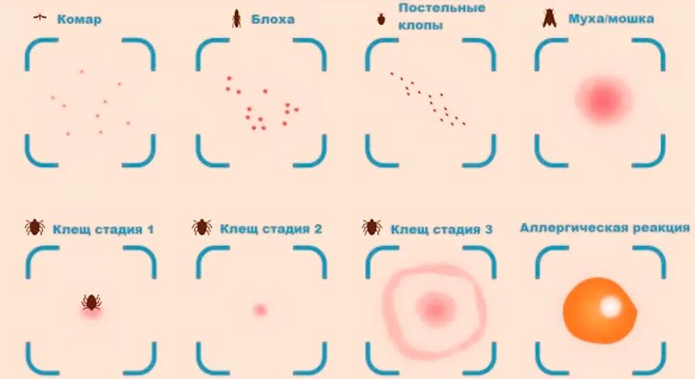 Показать укусы клопов на теле человека фото Укус клеща - фото, симптомы, последствия