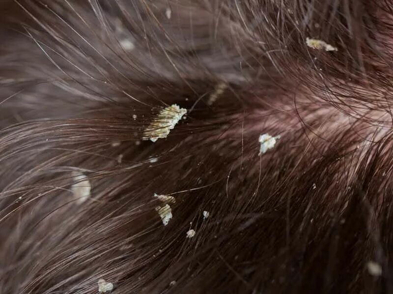 Покажи фотку как выглядят вши Scalp Build Up: Don’t Mistake It For Dandruff! - Lewigs