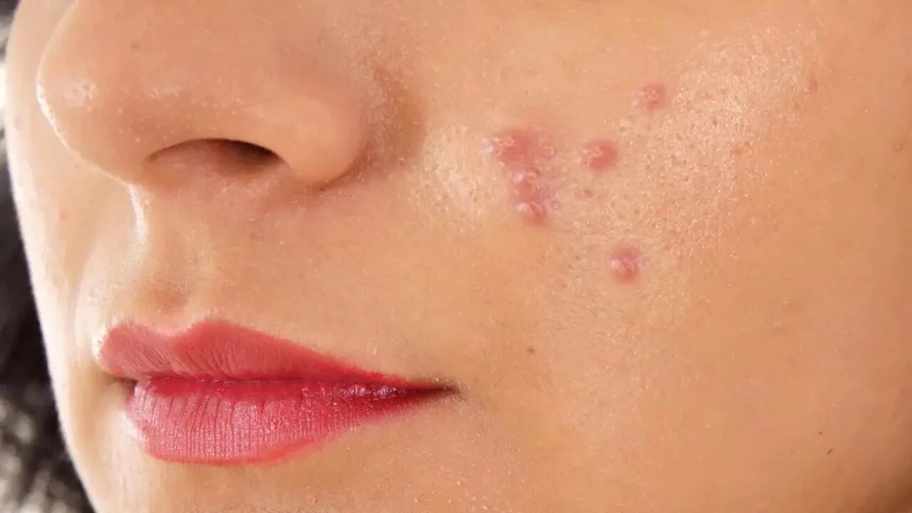 Покажи фото герпеса Oily Skin Pimples Remove At Home / Oily Skin Se Pimple Hatane Ka Tarika - YouTub