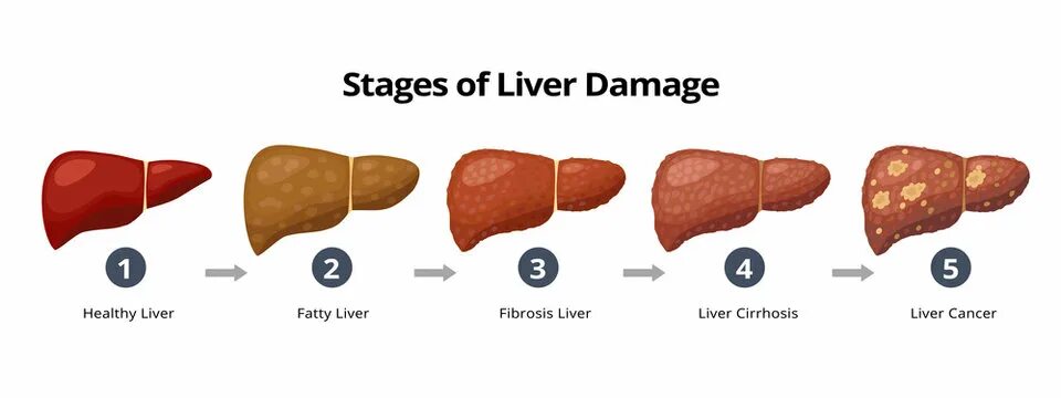 Покажи фото печени Liver Cirrhosis Зображення - огляд 15,816 Стокові фото, векторні зображення й ві