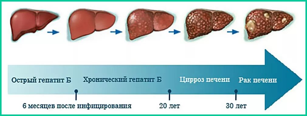 Покажи фото печени Рак печени клинические