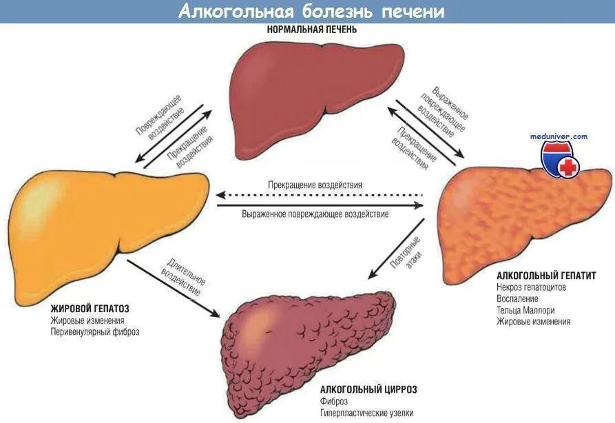 Покажи фото цирроза печени Цирроз и фиброз печени клинические рекомендации