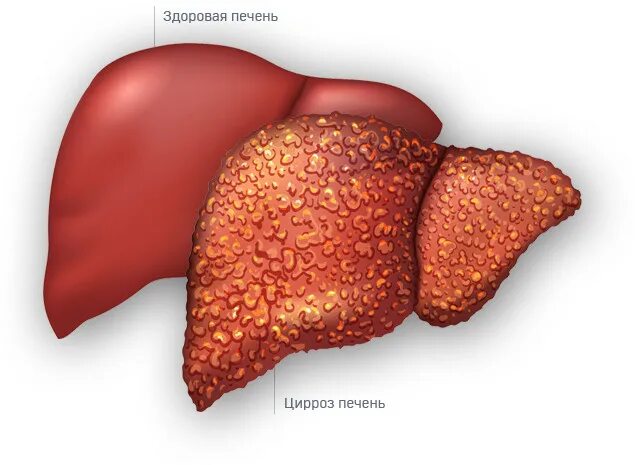 Покажи фото цирроза печени ✔ Алкогольный цирроз печени: симптомы, причины, последствия Методы лечения цирро